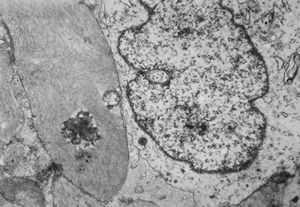 M,11y. | fibrillary astrocytoma M,11y. | fibrillary astrocytoma